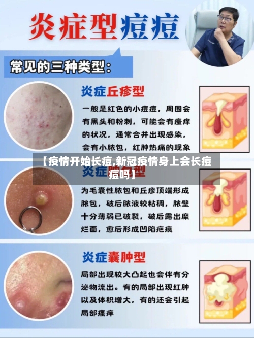 【疫情开始长痘,新冠疫情身上会长痘痘吗】