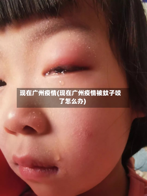 现在广州疫情(现在广州疫情被蚊子咬了怎么办)-第2张图片