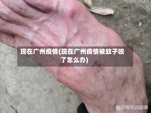 现在广州疫情(现在广州疫情被蚊子咬了怎么办)