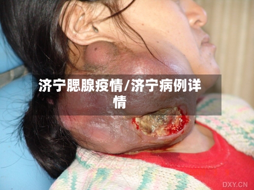 济宁腮腺疫情/济宁病例详情-第2张图片